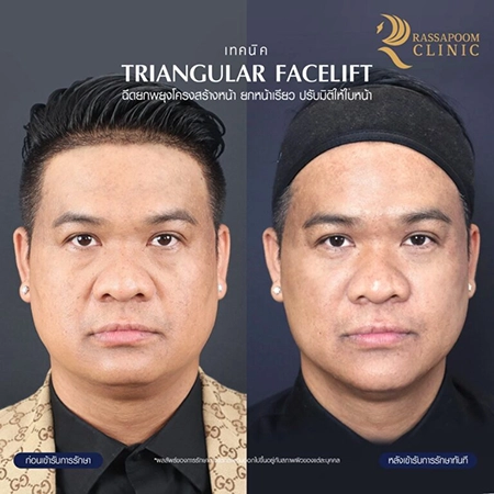 ภาพก่อน - หลัง ฉีดฟิลเลอร์ (เทคนิค Triangular Face Lift)