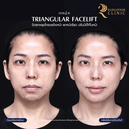 ภาพก่อน - หลัง ฉีดฟิลเลอร์ (เทคนิค Triangular Face Lift)