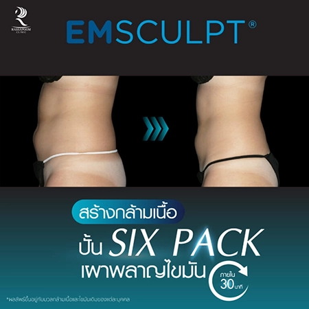 Emsculpt สร้างกล้ามเนื้อ ลดไขมัน