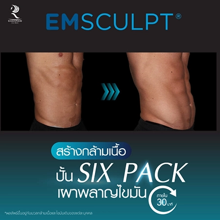 Emsculpt สร้างกล้ามเนื้อ ลดไขมัน