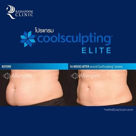 CoolSculpting Elite สลายไขมันด้วยความเย็น