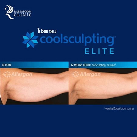 CoolSculpting Elite สลายไขมันด้วยความเย็น