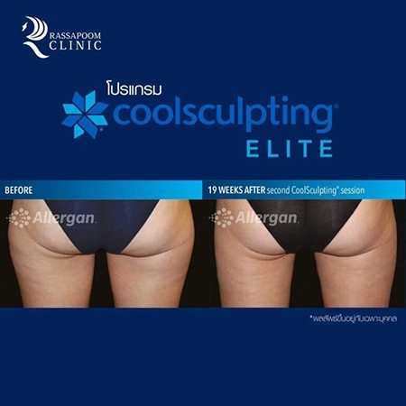 CoolSculpting Elite สลายไขมันด้วยความเย็น