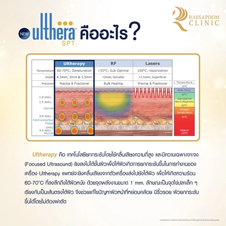 Ulthera ยกกระชับผิว