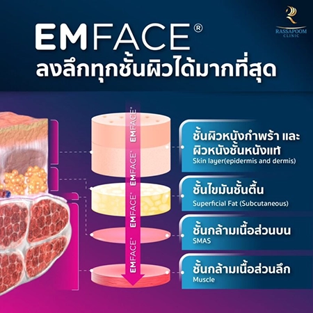 ยกกระชับกล้ามเนื้อ ยกกระชับ EMFACE