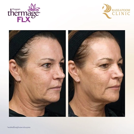 Thermage FLX ยกกระชับ