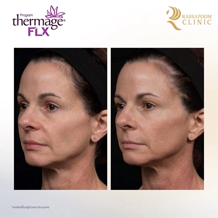 Thermage FLX ยกกระชับ