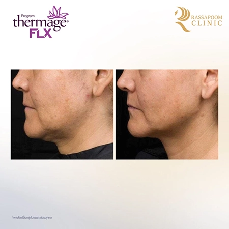 Thermage FLX ยกกระชับ