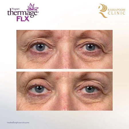 Thermage FLX ยกกระชับ