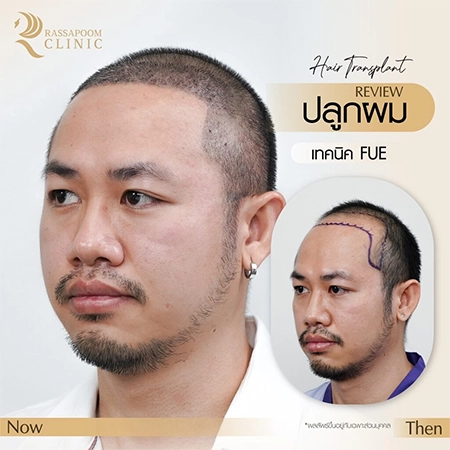 ปลูกผมถาวร FUE