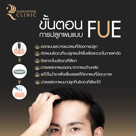 ปลูกผมถาวร FUE