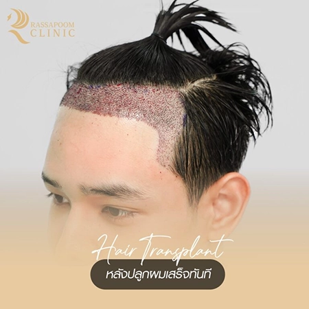 ปลูกผมถาวร FUE