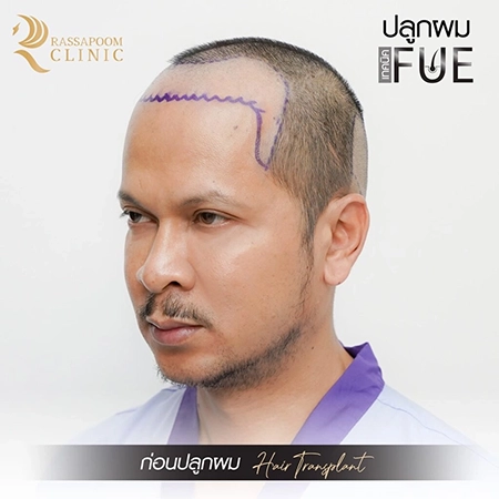 ปลูกผมถาวร FUE