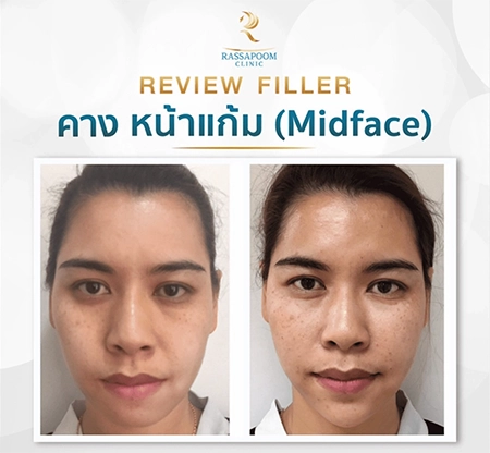 ฉีดฟิลเลอร์แก้มส้ม (Midface)