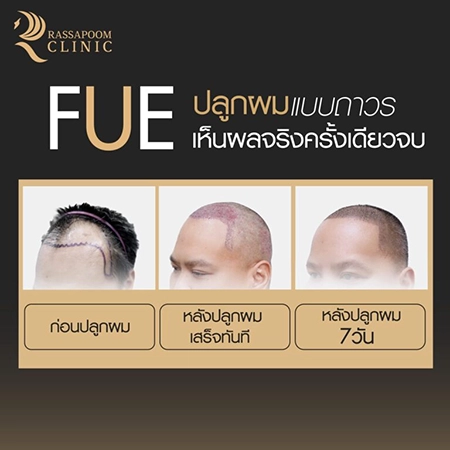 FUE ปลูกผมแบบถาวร