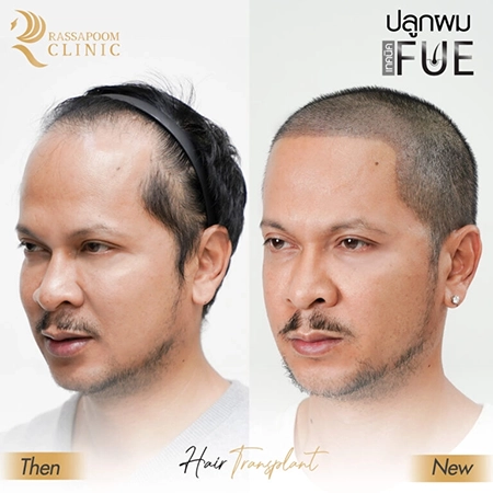 ปลูกผม FUE คุณแช่ม แช่มรัมย์