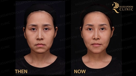 Triangular Face Lift