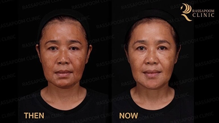 Triangular Face Lift