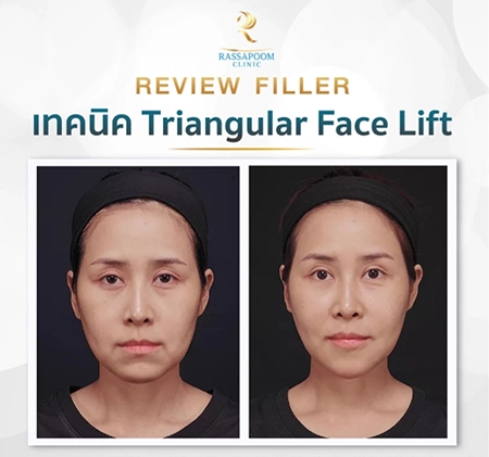 Triangular Face Lift