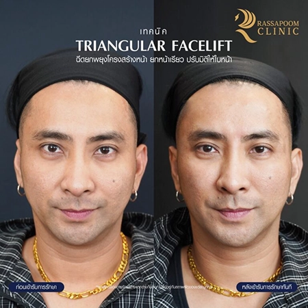 ฉีดฟิลเลอร์ (Triangular Face Lift)