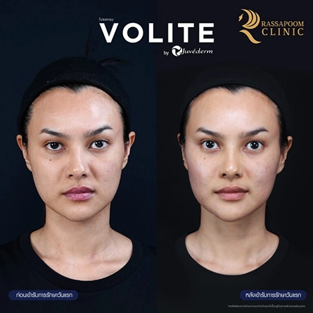 ฉีดฟิลเลอร์ (New Juvederm Volite)