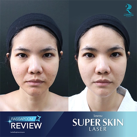 Super Skin Laser คุณปอย กนกนันท์ สุวรรณพฤกษ์