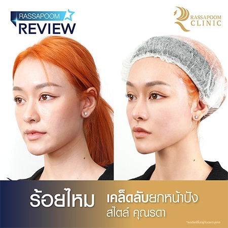 ร้อยไหม คุณรดา ดุษยารินทร์