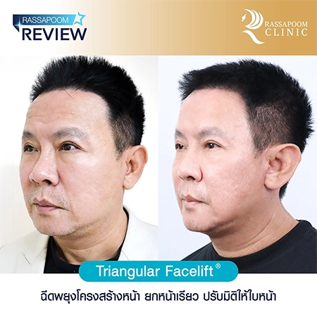 Triangular Face Lift ลุงรงค์