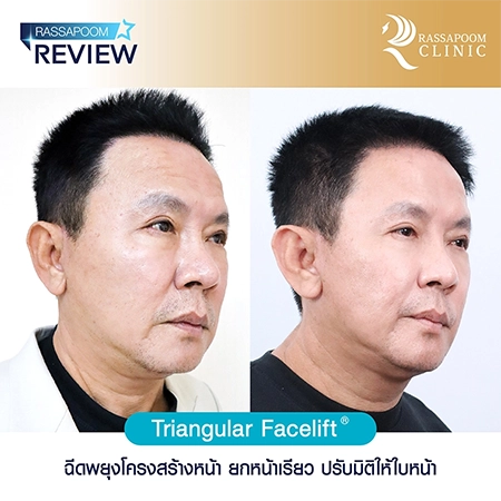 Triangular Face Lift ลุงรงค์