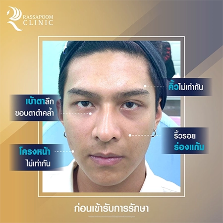 Triangular Face Lift คุณโหน ธนากร ศรีบรรจง