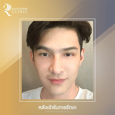 Triangular Face Lift คุณโหน ธนากร ศรีบรรจง