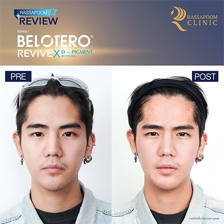 Belotero Revive (คุณนิก คุณาธิป ปิ่นประดับ)