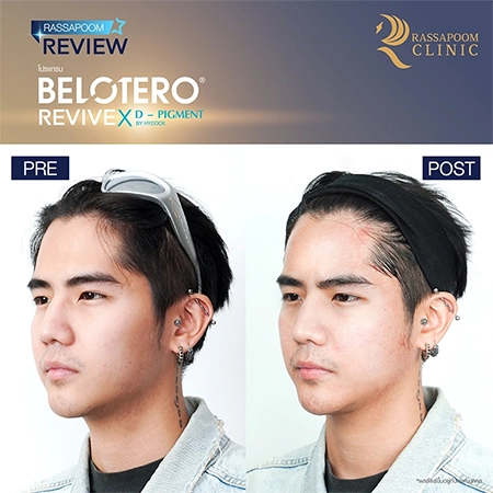 Belotero Revive (คุณนิก คุณาธิป ปิ่นประดับ)