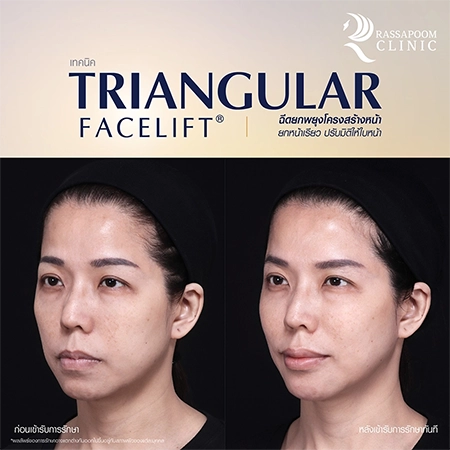 Triangular Face Lift คุณนก วาสนา