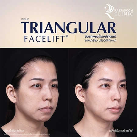 Triangular Face Lift คุณนก วาสนา