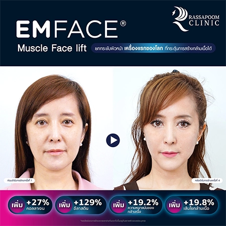 Emface ยกกระชับผิวหน้า (คุณต่าย สายธาร นิยมการณ์)