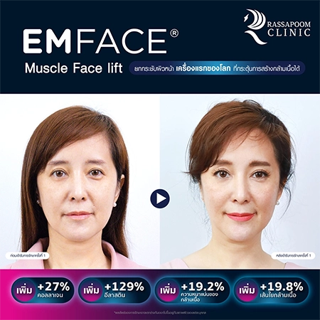 Emface ยกกระชับผิวหน้า (คุณต่าย สายธาร นิยมการณ์)