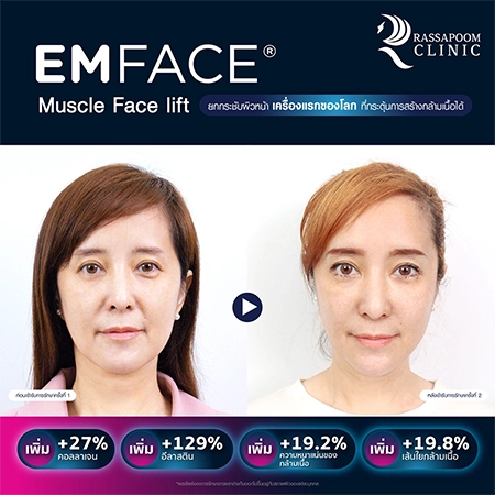 Emface ยกกระชับผิวหน้า (คุณต่าย สายธาร นิยมการณ์)