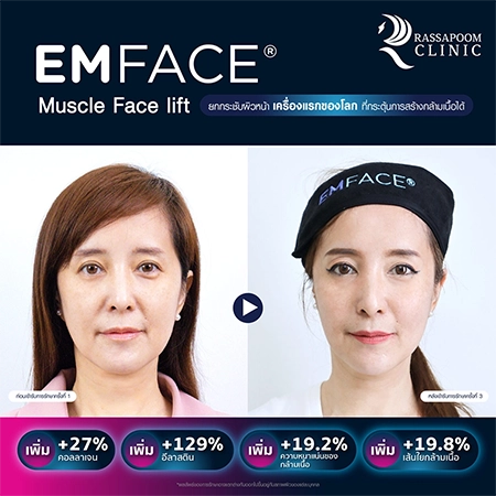 Emface ยกกระชับผิวหน้า (คุณต่าย สายธาร นิยมการณ์)