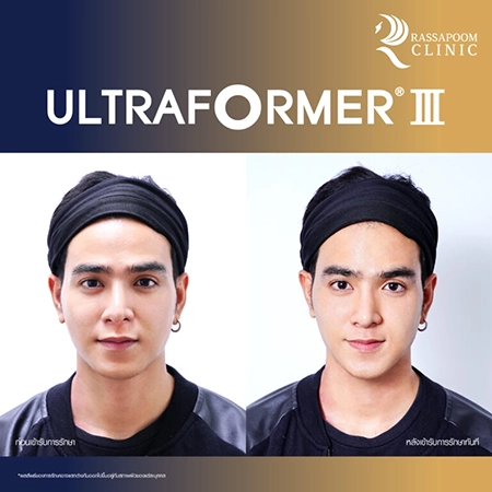 Ultraformer III (คุณโต๊ส อัครัช จิตตะศิริ)