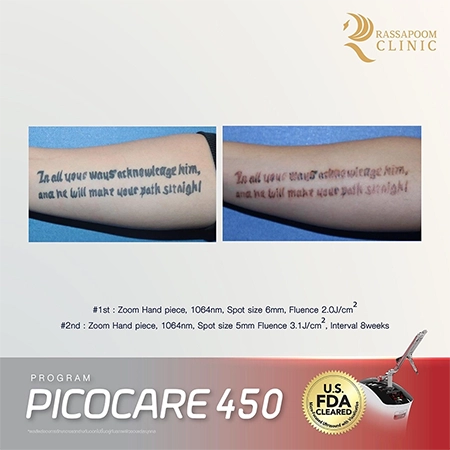 Picocare 450 Laser