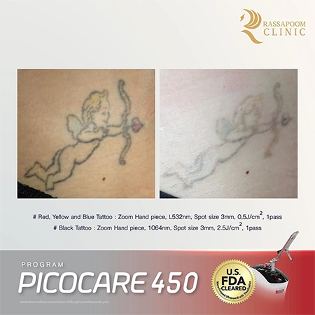 Picocare 450 Laser