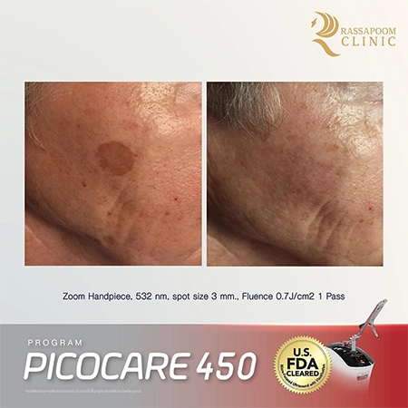 Picocare 450 Laser