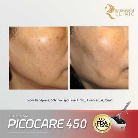 Picocare 450 Laser