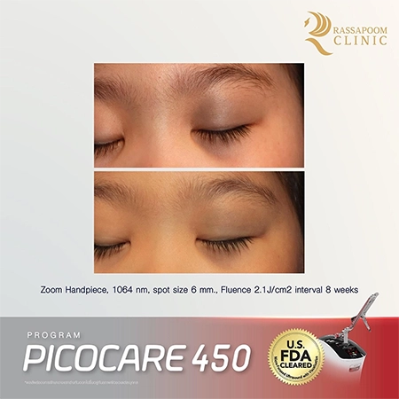 Picocare 450 Laser