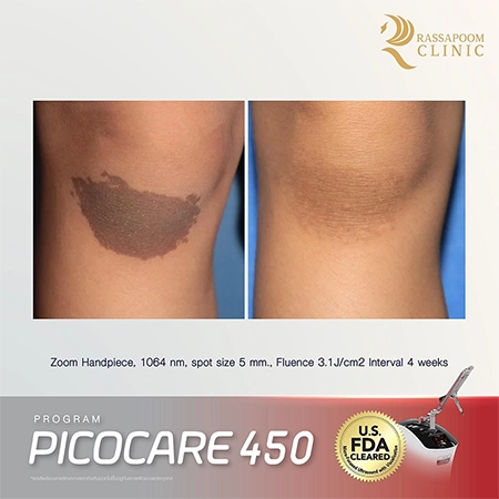 Picocare 450 Laser