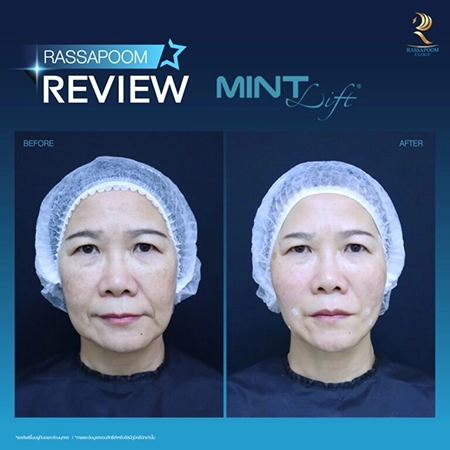 ร้อยไหมมิ้นท์ Mint Lift (คุณพัชร์)