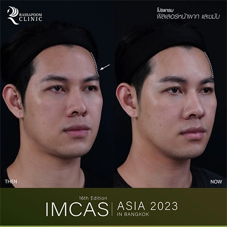 IMCAS ASIA 2023