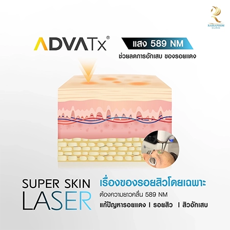 Super Skin Laser รักษาฝ้า กระ และจุดด่างดำ