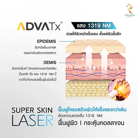 Super Skin Laser รักษาฝ้า กระ และจุดด่างดำ